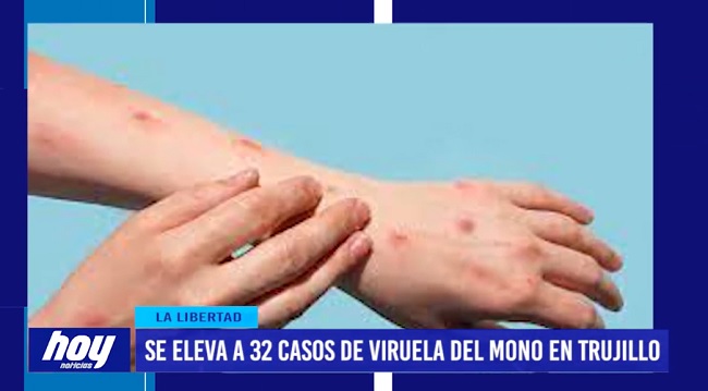 viruela Se eleva a 32 casos de viruela del mono en Trujillo